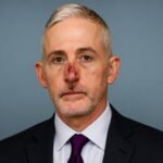 What Happened to Trey Gowdy’s Nose? Truth Explained