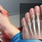 Big Toe Swelled Up? Common Causes, Symptoms, and When to Worry