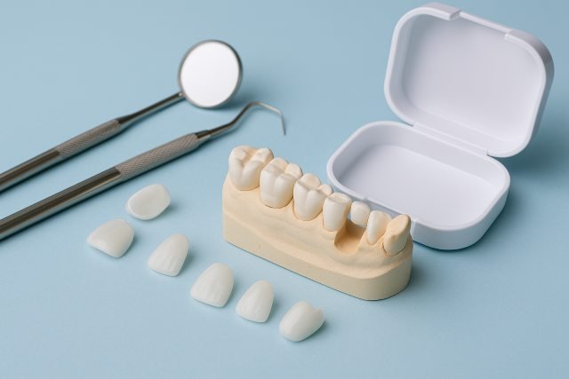 Are Dental Veneers for Missing Teeth a Good Idea? Pros, Cons, and Alternatives